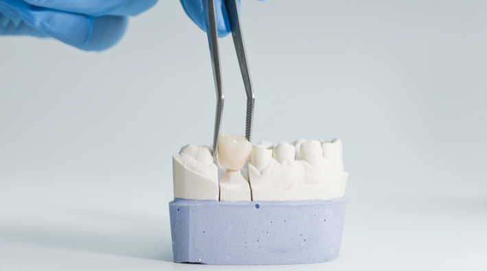 Kronen aus dem 3D-Drucker? Moderne Zahntechnik ohne lange Wartezeiten in der Region Baden