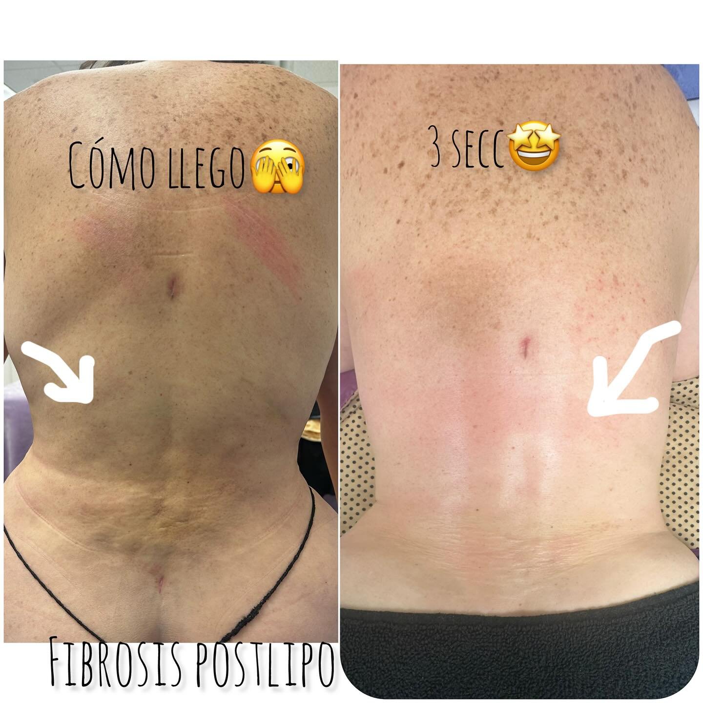 🫡🫣CHICAS ES MUY IMPORTANTE QUE SE ASEGUREN QUIEN TE REALIZAR&Aacute; TUS MASAJES POST QUIR&Uacute;RGICOS 👌 YA QUE EL@EXITO DE TU CIRUG&Iacute;A ESTE PROCESO DONDE NOSOTRAS COML ESTETICISTAS TE AYUDAMOS A DESINFLAMAR A ELIMINAR L&Iacute;QUIDOS RETE