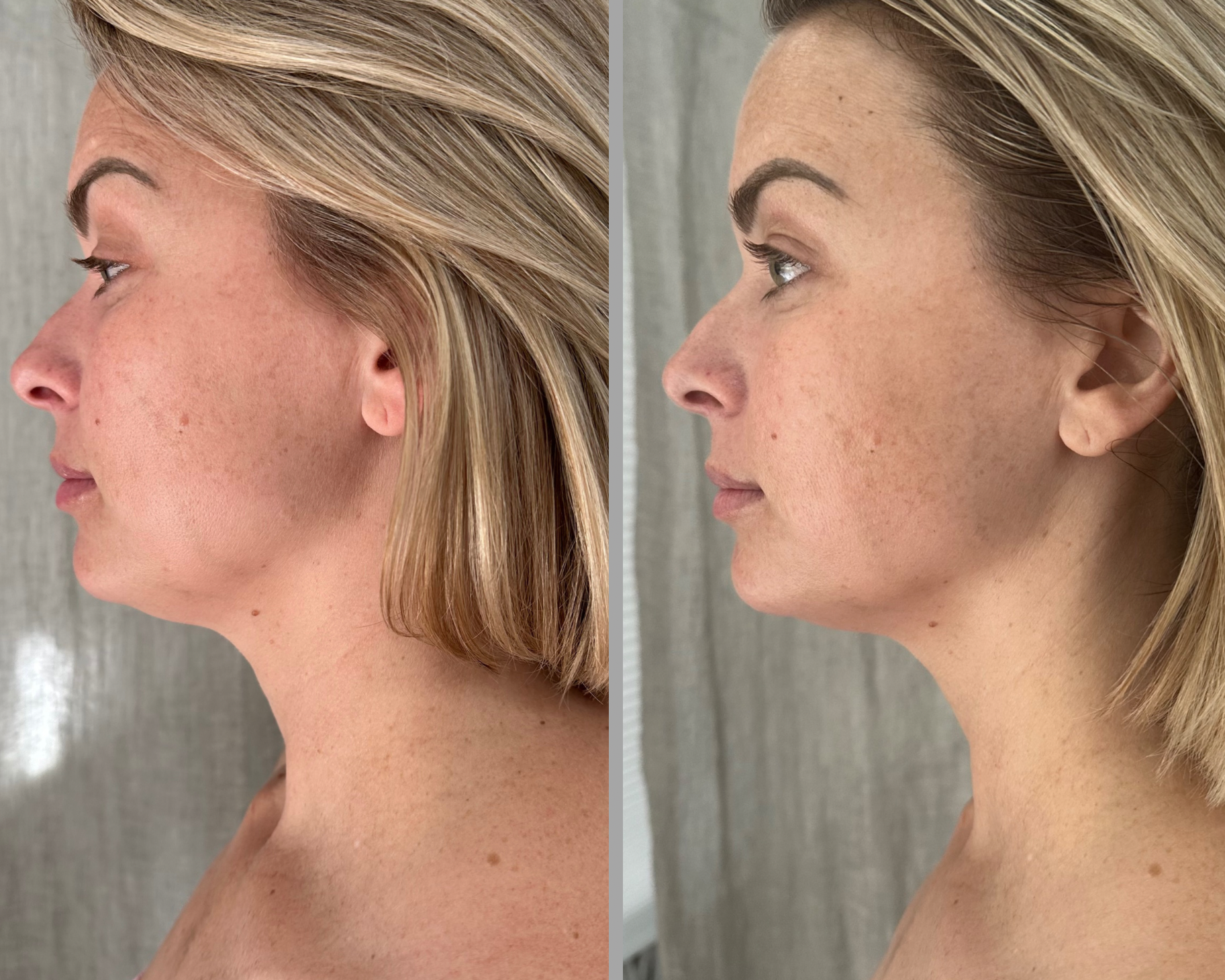 Before & After: Lift & Glow Facial with Buccal 90 Minutes