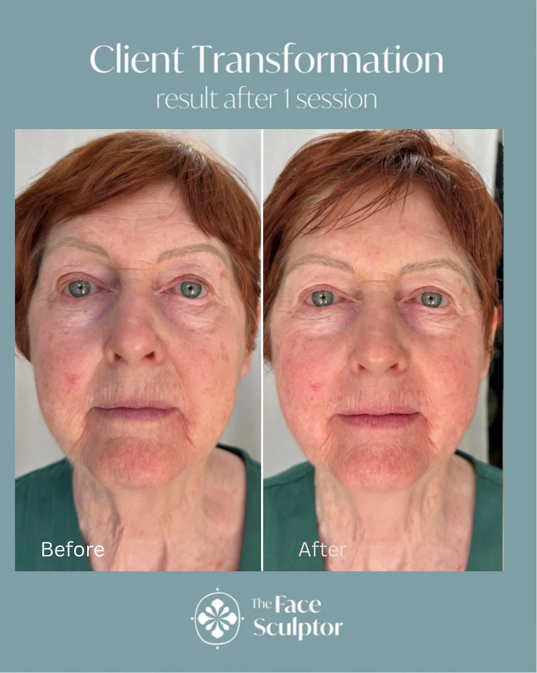 Before & After: Result after 1 session