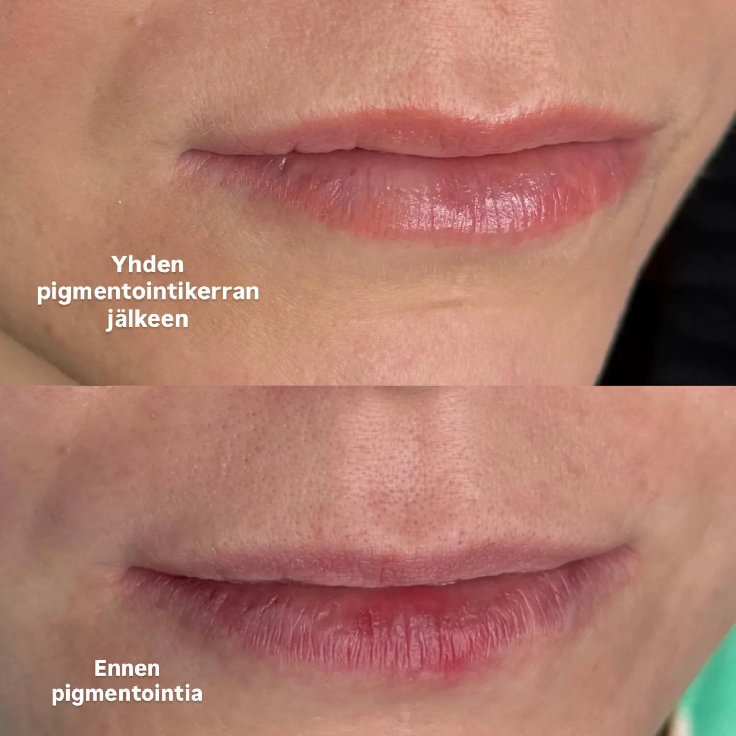 Milt&auml; huulten pigmentointi tulee n&auml;ytt&auml;m&auml;&auml;n parantuneena? 💋 kurkkaa postauksen kuvat parantuneista huulista yhden k&auml;sittelyn j&auml;lkeen. 

- Pigmentoimalla voidaan taittaa huulista sinert&auml;v&auml;&auml; s&auml;vy&