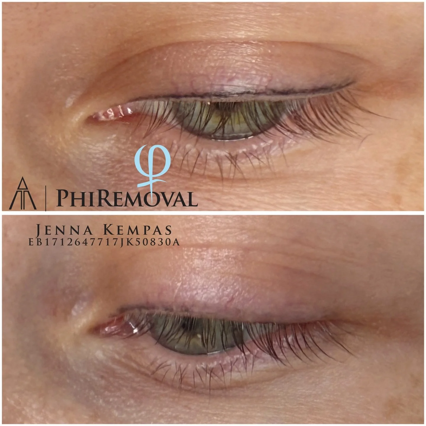 PhiRemoval pigmentinpoisto? 🩵

PhiRemovalilla voidaan poistaa vanhoja tai ep&auml;mieluisia pigmentointeja kulmien, huulten tai silm&auml;rajausalueilta. Poistokertojen m&auml;&auml;r&auml; on yksil&ouml;llinen, usein tarvitaan 1-6 poistokertaa, poi