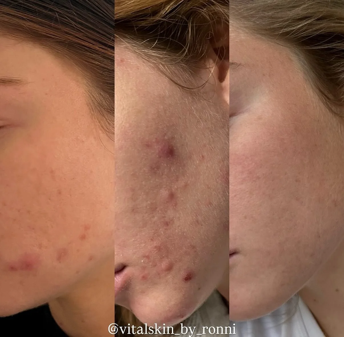 ✨ Clear Skin Takes Time ✨
This amazing transformation is all thanks to @vitalskin_by_ronni 💆&zwj;♀️

&bull; Start: December 2024 &ndash; homecare to calm redness + prep the skin
&bull; Purging: February 2025 &ndash; the tough but necessary phase as 