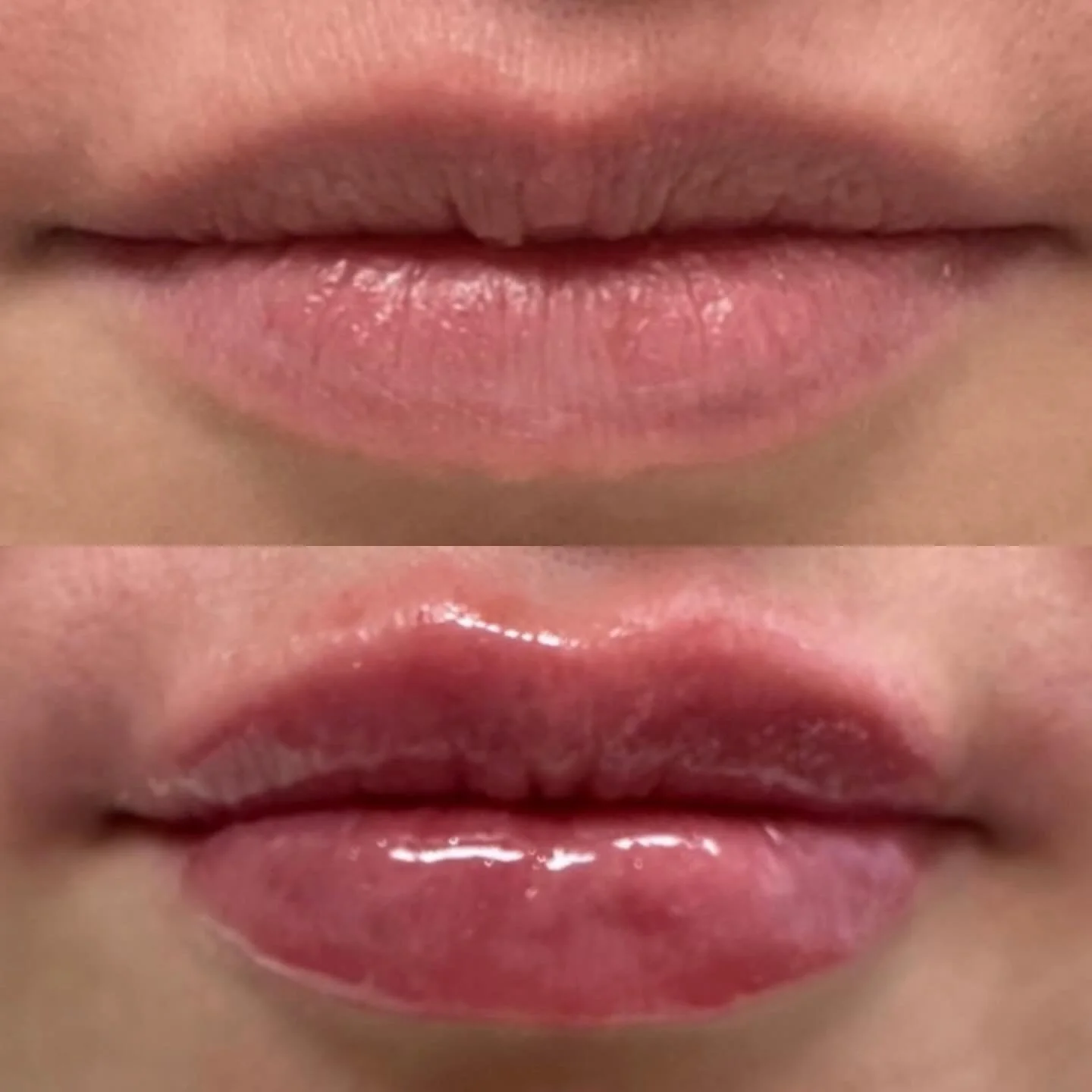 Subtle, balanced, and beautifully natural&mdash;the perfect refresh for a soft, kissable pout.
Expertly crafted by @erintheinjector 💉💖

 #LipFiller #BeforeAndAfter #NaturalResults