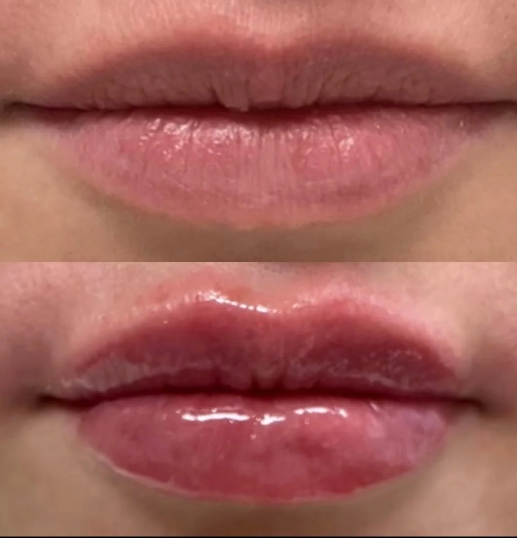 The perfect pout ✨
Soft volume. Seamless shape. Natural balance.
Lips by @erintheinjector 🤍