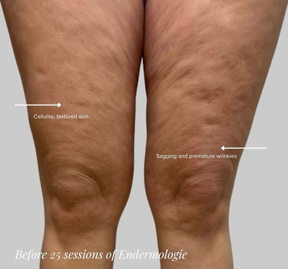 ✨ From dimples to divine ✨
Because luxury isn&rsquo;t just a look &mdash; it&rsquo;s a feeling.

This transformation? It&rsquo;s not just skin-deep. It&rsquo;s confidence, elevated. Smoother, tighter skin, and a glow that lasts through every chapter 
