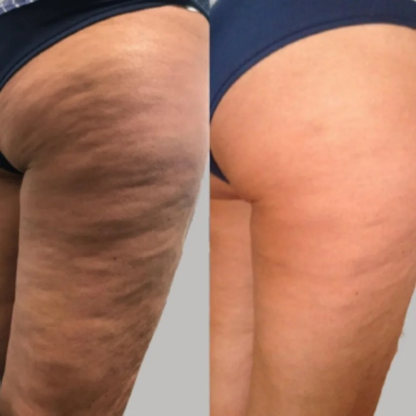 Bye bye cellulite 👋🏻

For appointments or consultations DM🤳🏻 or visit our website💻
🏢 606 120th Ave NE, Bellevue, WA 98005
.
.
.
.

Seattle Endermologie. Bellevue endermolgie. Lymphatic drainage massage. Cellulite reduction. Bellevue medspa. Bod