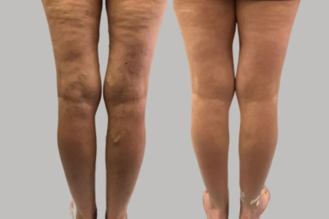 Before &amp; After Endermologie ✨ Look at the visible difference in those veins &mdash; from dark, prominent, and raised to dramatically smoother and less visible. No surgery, no injections. Just targeted therapy that actually works. 🙌

For appointm