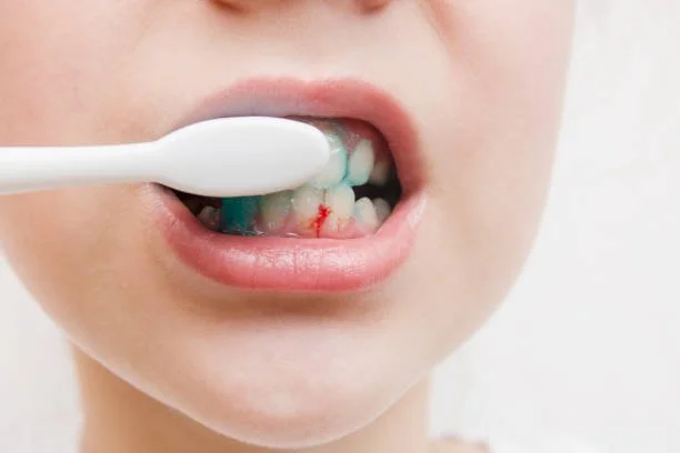 Why My Child’s Gums Bleed — And What We Did About It
