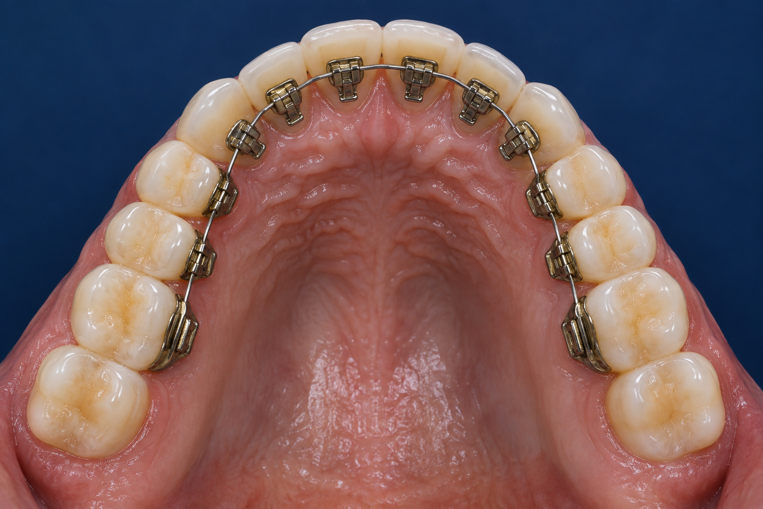 Customised WIN lingual braces fitted to the inner surfaces of the teeth