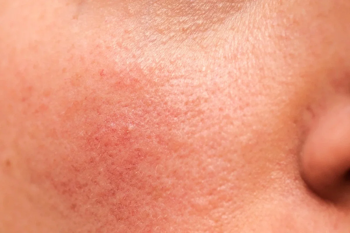 Close-up of facial redness and irritation showing a compromised skin barrier in spring