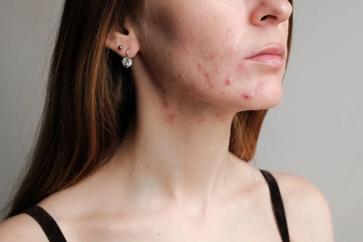 Hormonal acne and breakouts along the jawline during seasonal skin changes