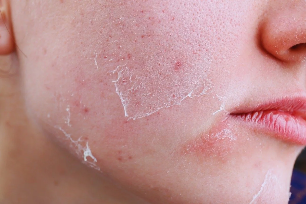 Flaking and irritation are often signs of barrier disruption—not a need for stronger products.