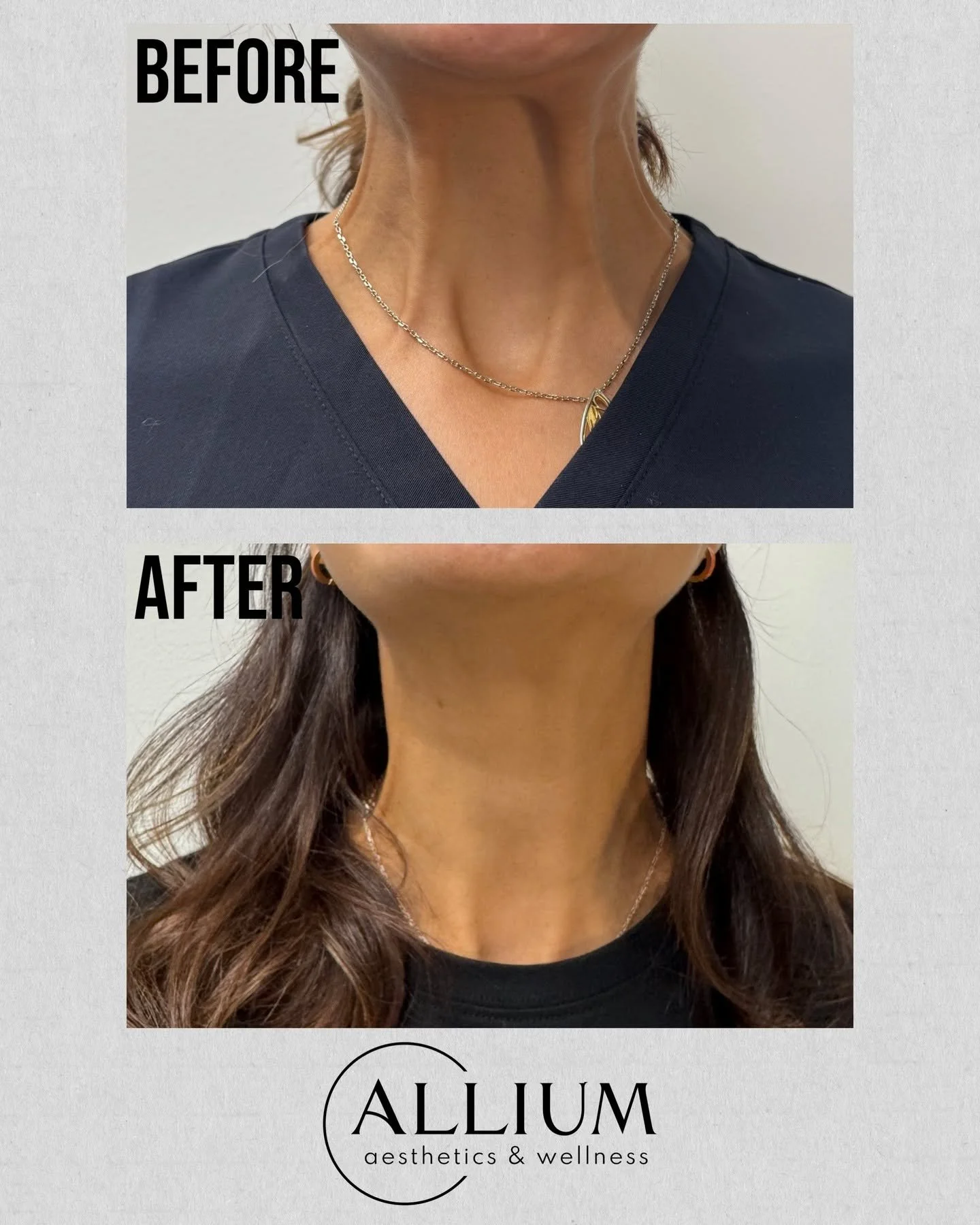 Next Available- Monday, September 29th

BOOK WITH US:
📞 Call us directly: (703)-828-1880
💌 Send us a DM
🔗 Tap the link in bio

At Allium Aesthetics and Wellness, we know confidence doesn&rsquo;t stop at the jawline. That&rsquo;s why we proudly use