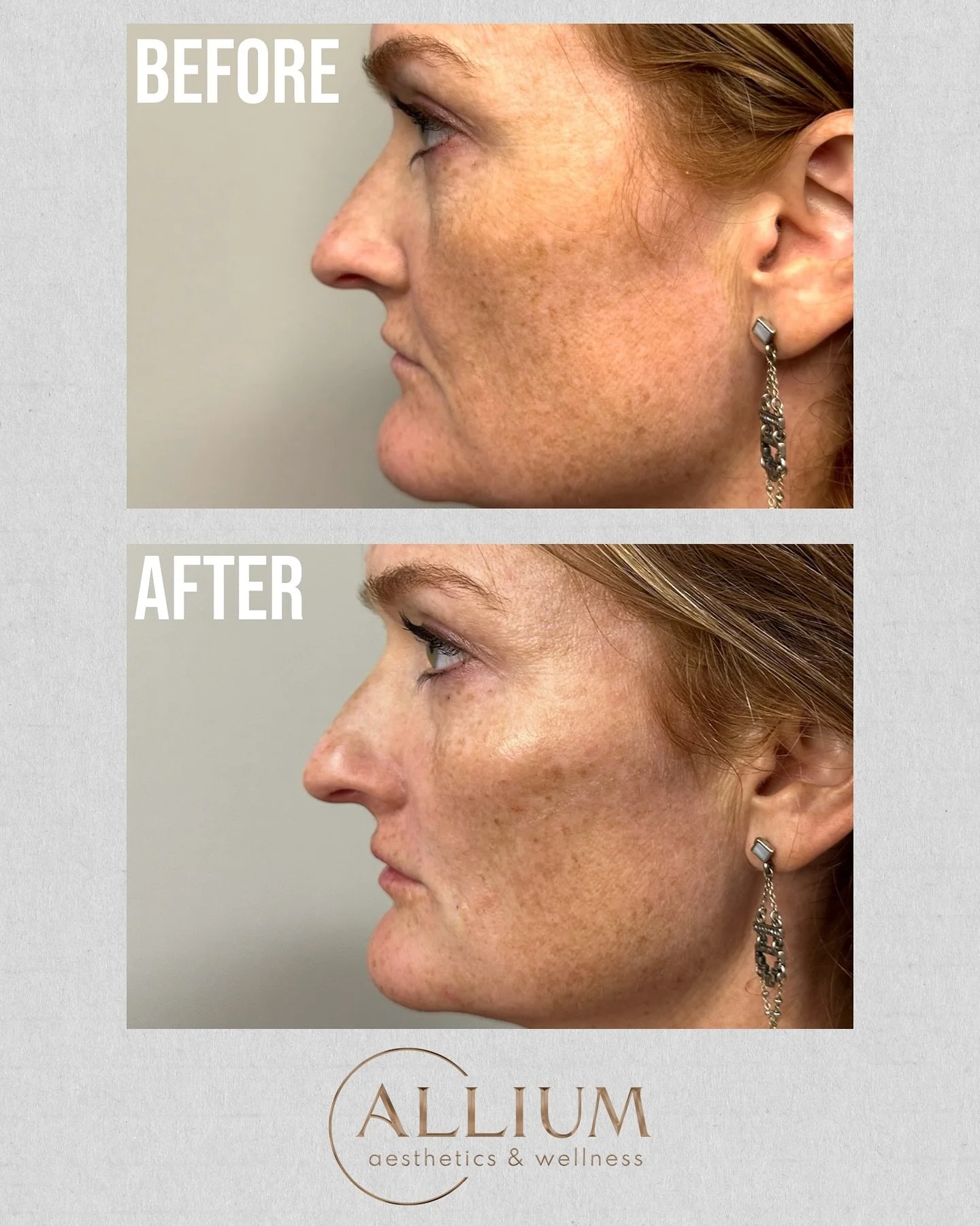 Refreshed. Hydrated. Naturally you.

Our newest addition, @evolyssebyevolus dermal filler, uses hyaluronic acid to hydrate and softly restore natural volume, improving elasticity and contour for a beautifully balanced result.

Next Available- Thursda