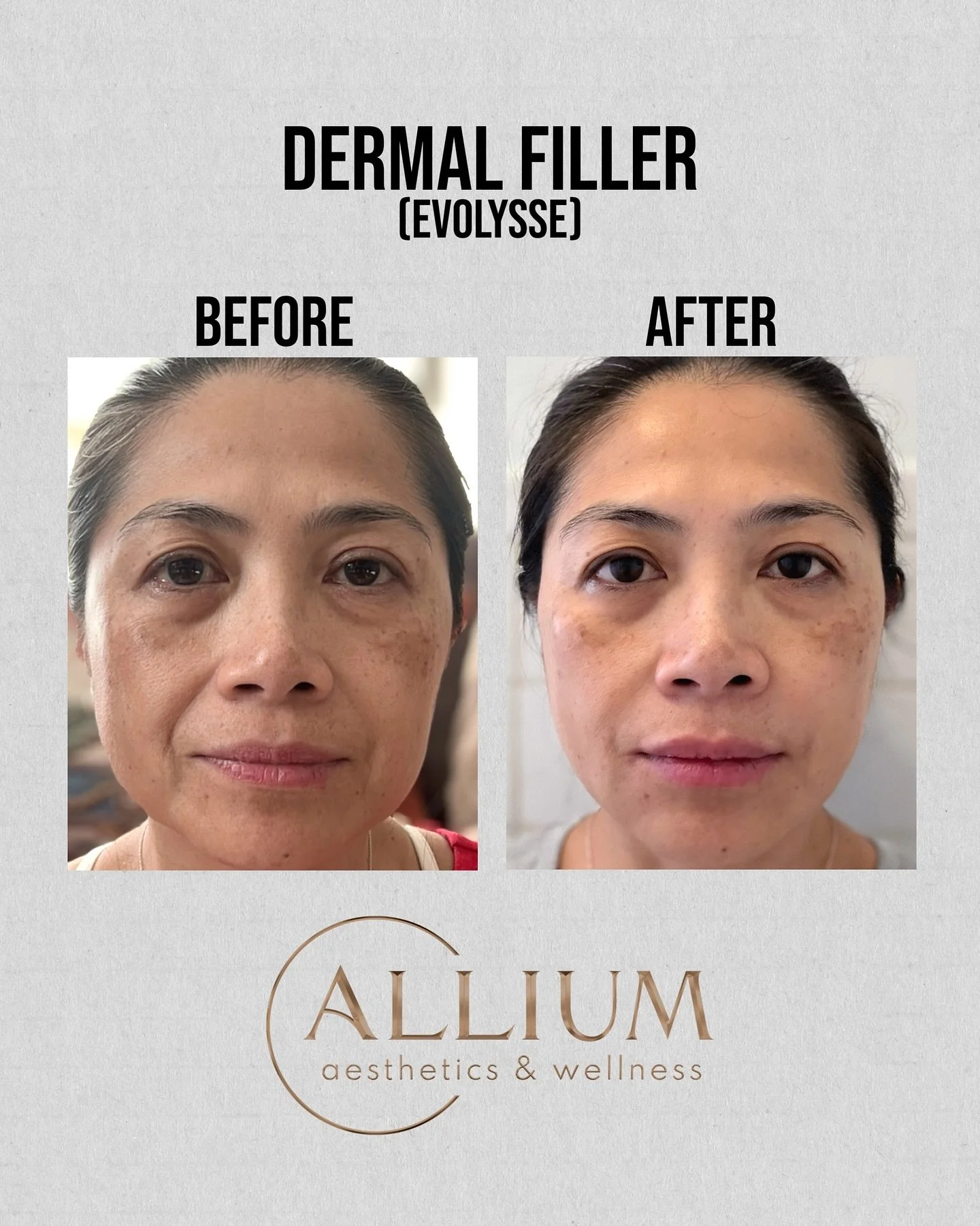 Formulated with hyaluronic acid, @evolyssebyevolus aligns perfectly with our philosophy: to enhance, not alter. 
This full-face rebalancing treatment softened the nasolabial folds, refined the lips and chin, and restored midface volume for a brighter