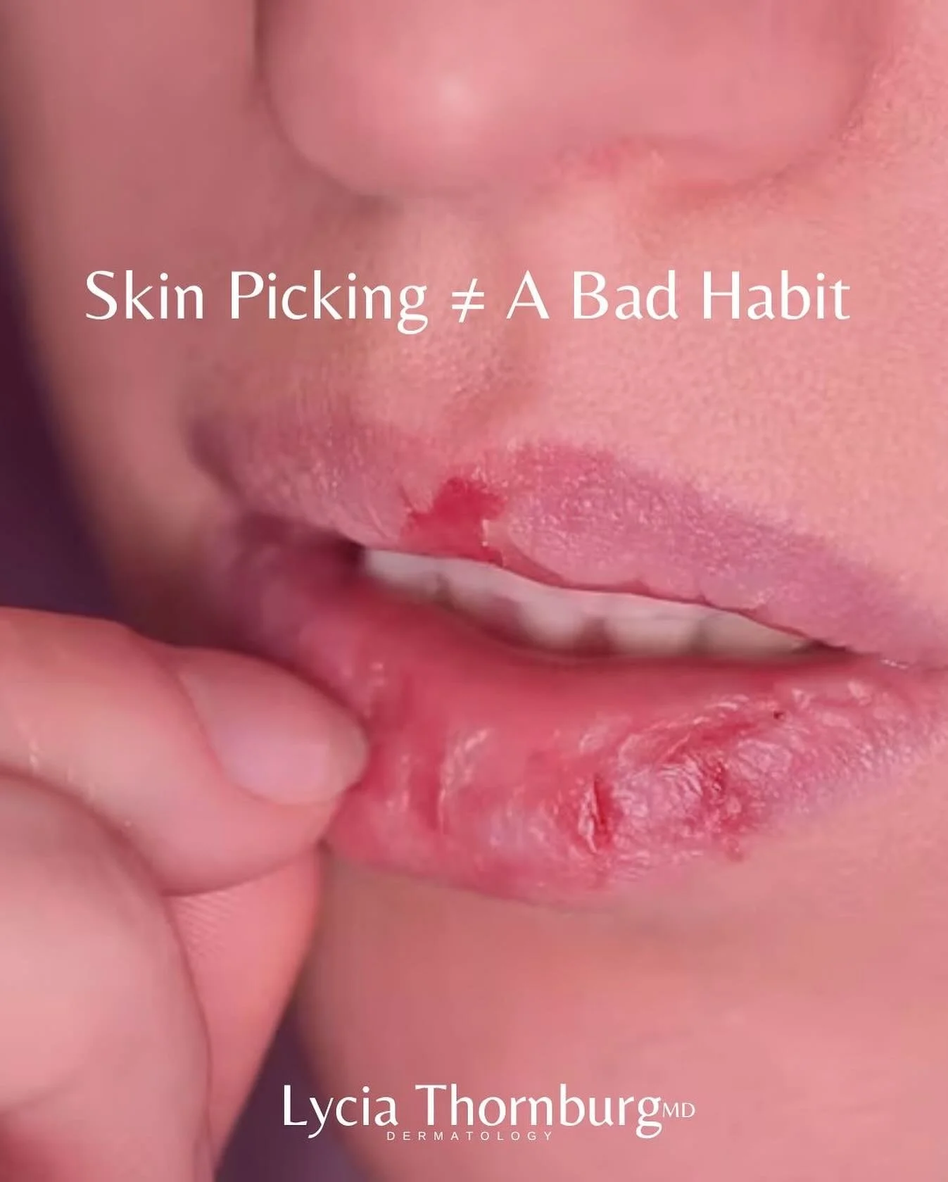 Skin picking (dermatillomania) isn&rsquo;t a &lsquo;bad habit.&rsquo;
 It&rsquo;s a body-focused repetitive behavior, and millions struggle silently.
 Dermatology + mental health support can make a difference.
 This week, let&rsquo;s break the stigma
