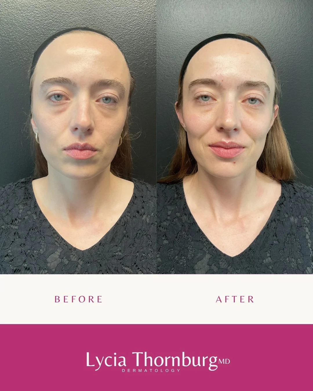 ✨ Full-Face Refresh ✨

This beautiful result was achieved with:
💙 Botox for soft, natural relaxation of fine lines and dynamic movement
💙 2 syringes of Juv&eacute;derm Voluma&reg; to restore gentle lift and contour through the midface

The goal? A 