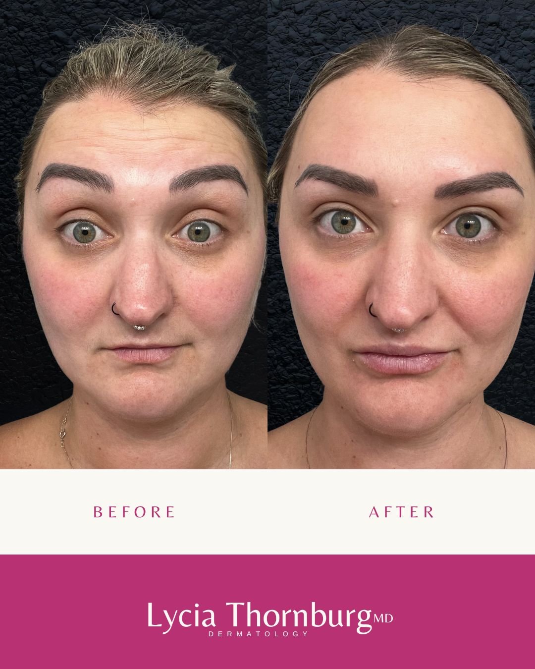 Botox should whisper, not shout. 💉✨
A few carefully placed units softened frown lines and lifted her overall expression &mdash; while keeping her completely her.

That&rsquo;s the beauty of personalized dosing and expert technique: subtle, natural, 