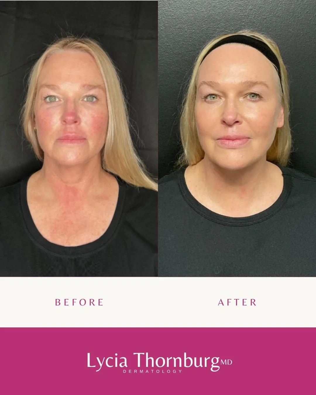 Over the course of a year, subtle tweaks can create the most natural glow.&nbsp;🤩

Botox, filler, and BBL Heroic Sciton Laser &mdash; strategically layered thoughtfully &mdash; brought out her best while keeping everything authentically&nbsp;her. 💙