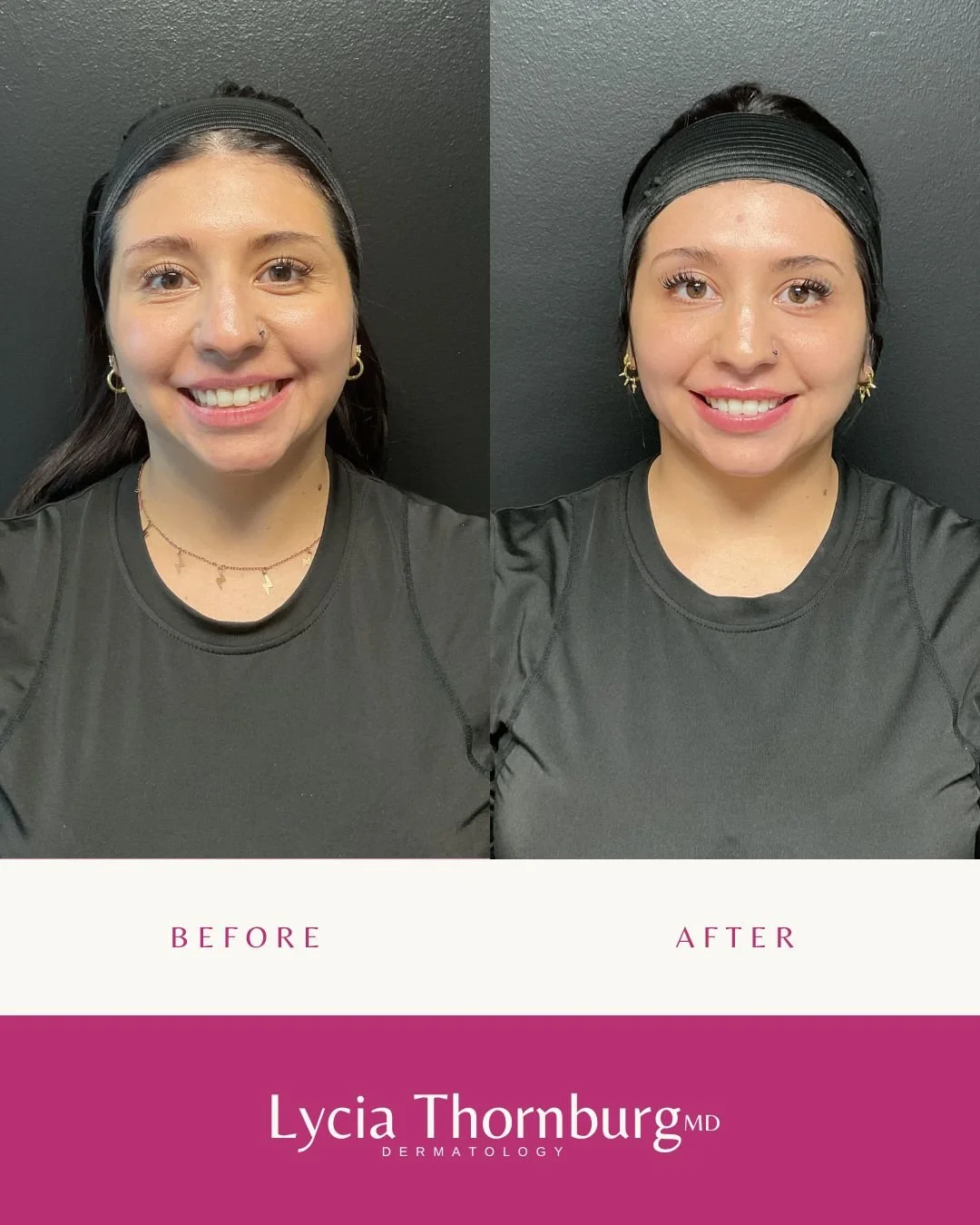 Precision matters. ✨

Using just 1 syringe of Ultra XC, we enhanced her upper and lower lips for soft, proportional volume that still looks like her &mdash; only more hydrated, more confident.