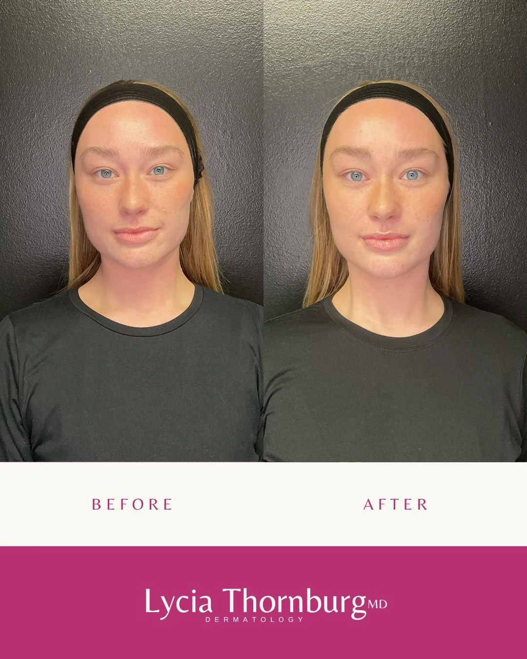 This isn&rsquo;t filler for volume &mdash; it&rsquo;s hydration for your skin. ✨

1 syringe of Skinvive is designed to improve skin quality, not change your features.
It works by delivering hyaluronic acid just beneath the surface to boost:
💧 Hydrat