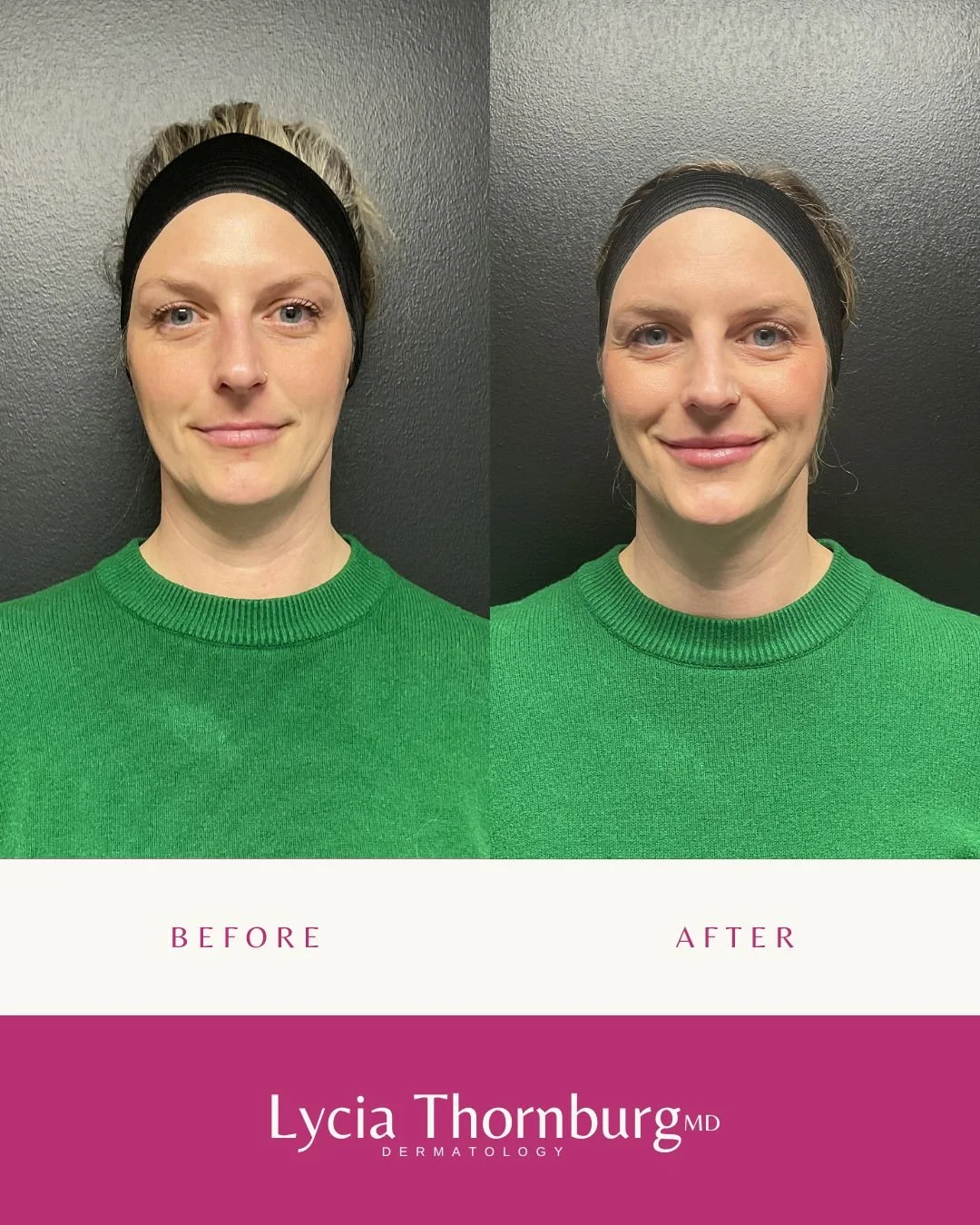 Subtle refinement. Thoughtful placement. Natural movement.

For this patient, we used 1cc of Volbella to the upper and lower cutaneous lip &mdash; focusing on structure and soft definition rather than volume alone.

When done correctly, lip filler sh