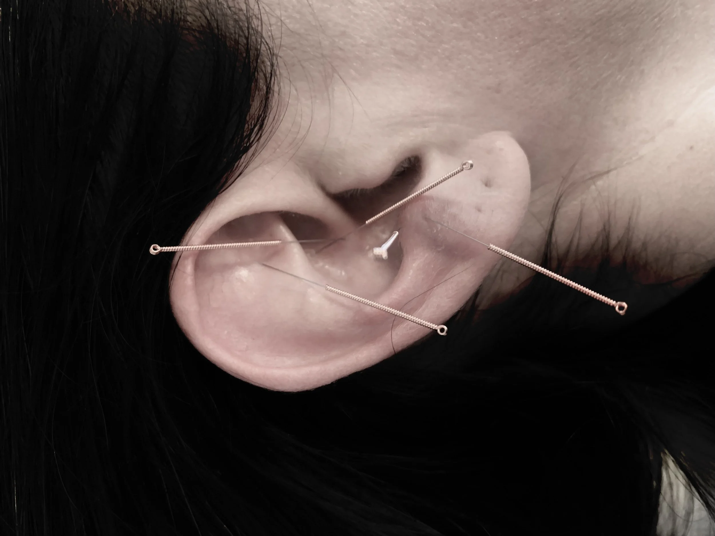 Inga Schulz Heilpraktikerin Hamburg Ohrakupunktur Migräne Tinnitus PMS