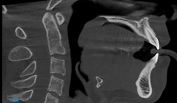 V16 Sagittal - 3 1.png