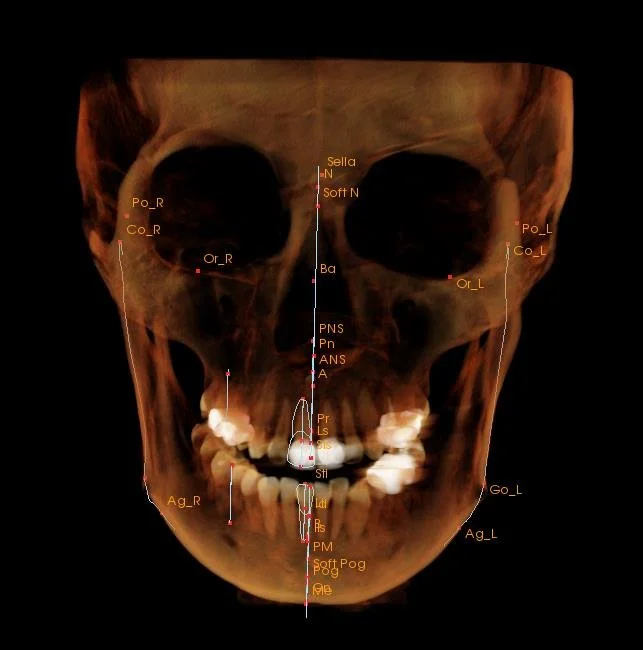 3D medical scan of a human skull showing detailed facial and dental structures with labels.