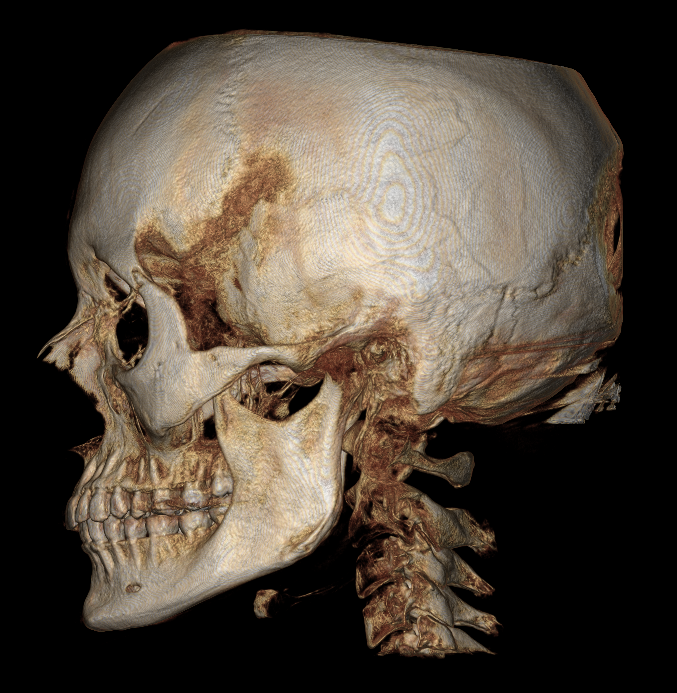 A 3D rendered side view of a human skull and upper cervical spine, showing detailed bone structures.