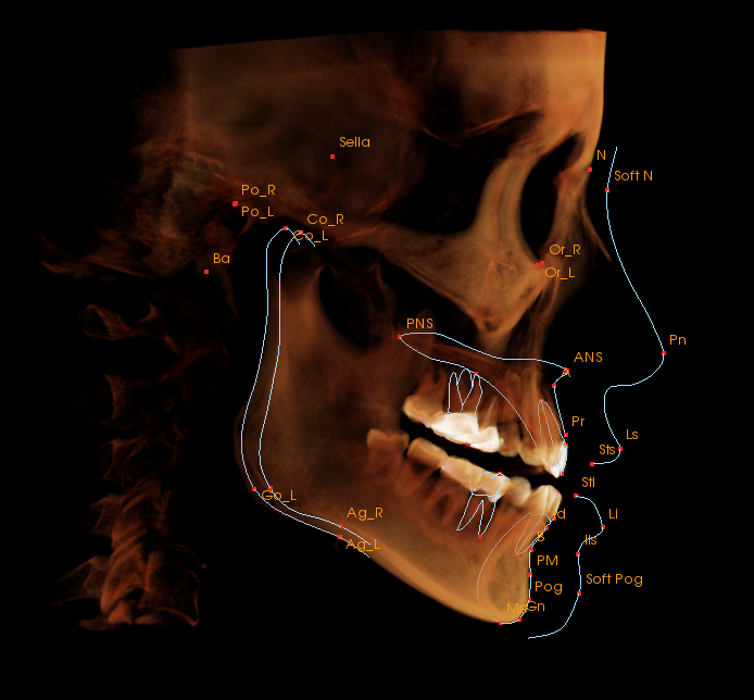 A lateral view of a human skull with dental and anatomical landmarks labeled in orange and blue lines indicating specific points and curves.