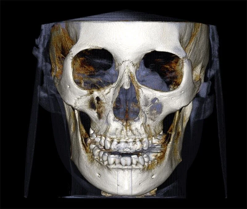 3D medical scan of a human skull, showing bones and eye sockets, with some surrounding tissue visible.