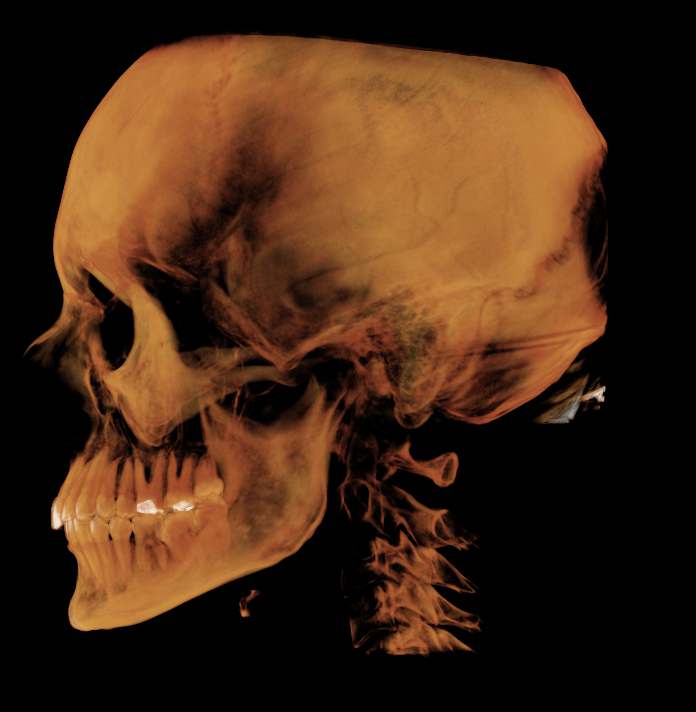 Side view of a human skull with a visible neck spine, set against a black background.