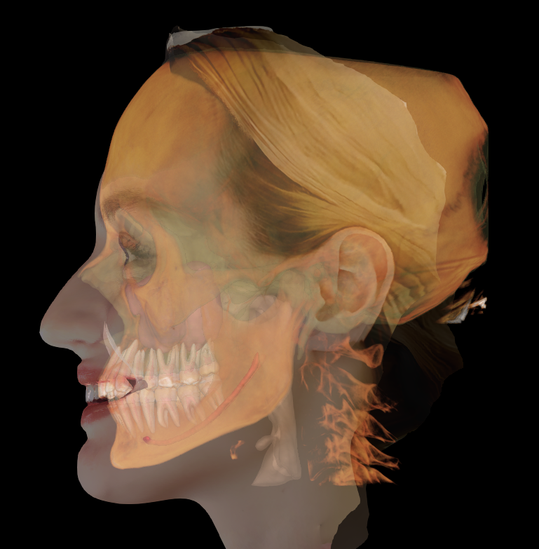 A side view of a human skull with a transparent overlay showing muscles and tissues inside the head.