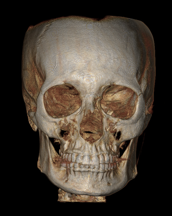 A 3D rendering of a human skull with visible eye sockets, nasal cavity, and teeth, displayed against a black background.