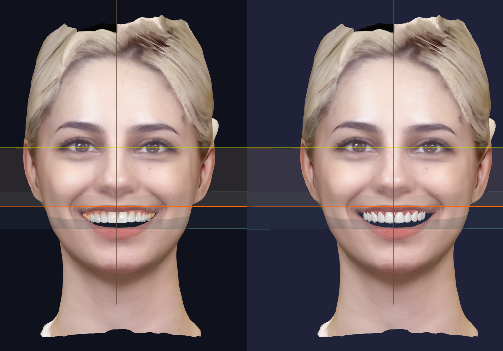 Comparison of a woman's face with smile and smile adjusted for symmetry, showing side-by-side views with lines indicating facial symmetry points.