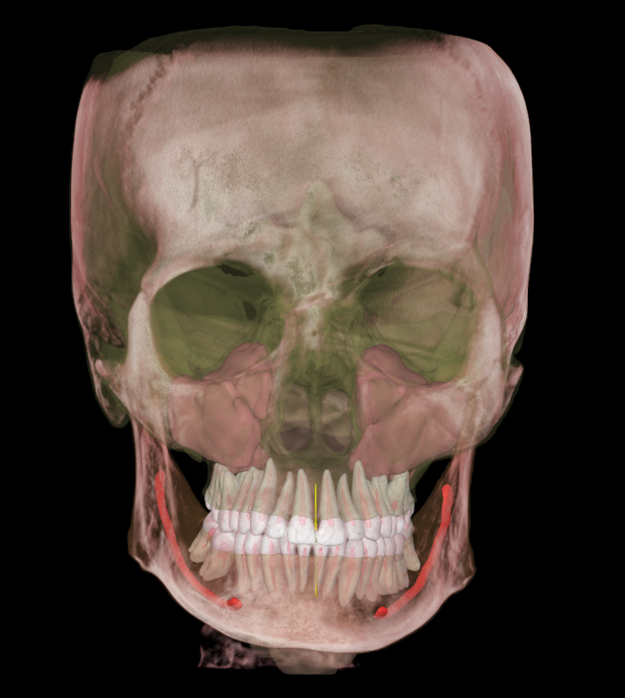 3D human skull with greenish sinuses, red highlighted jawline, and detailed teeth set.