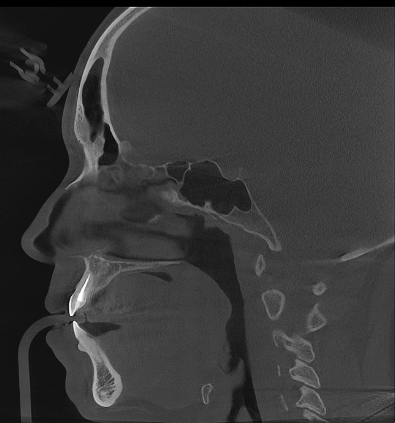 V18 Sagittal - 1 1.png