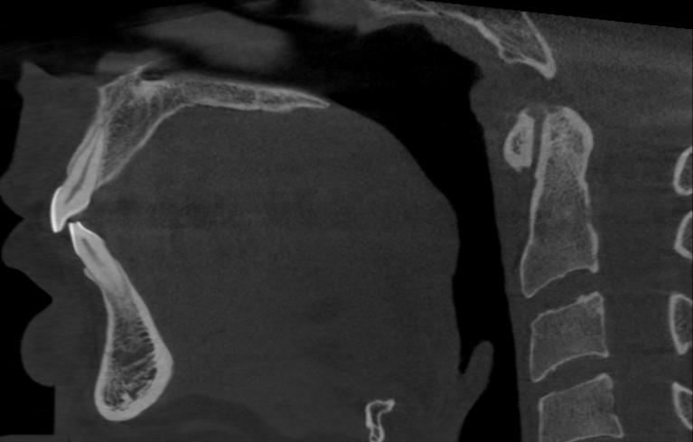 V16 Sagittal - 2 1.png