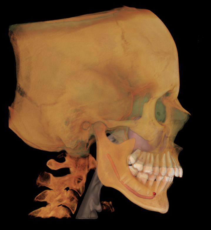A medical imaging scan of a human skull from the side, showing the bones and teeth.
