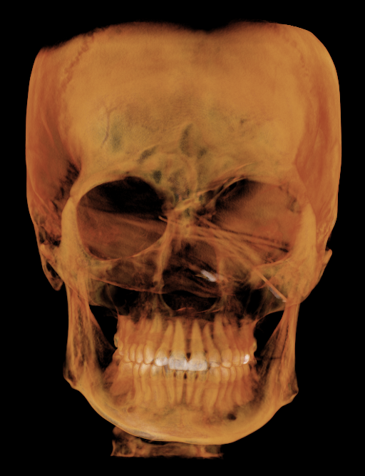 A human skull with a yellowish tint against a black background.