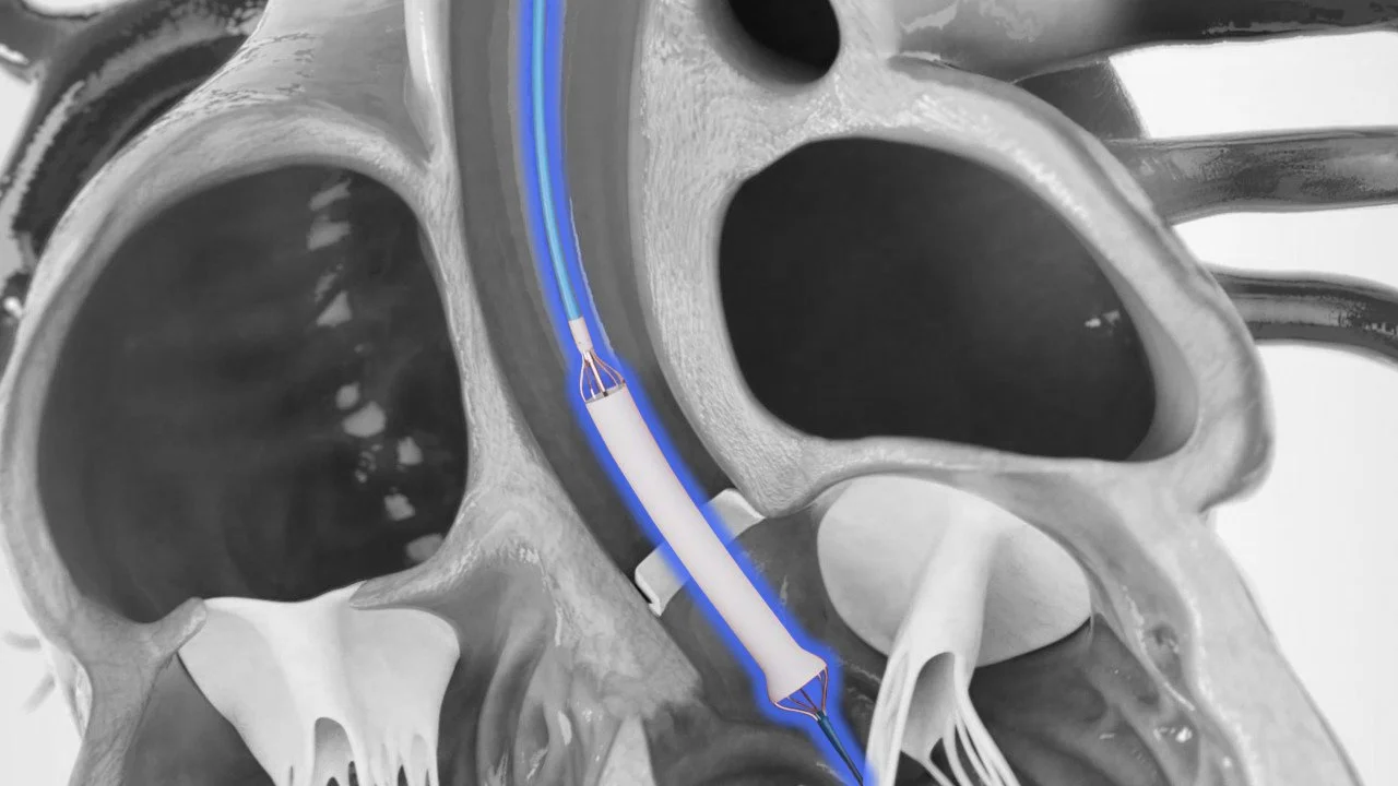 Transcatheter PVAD highlight