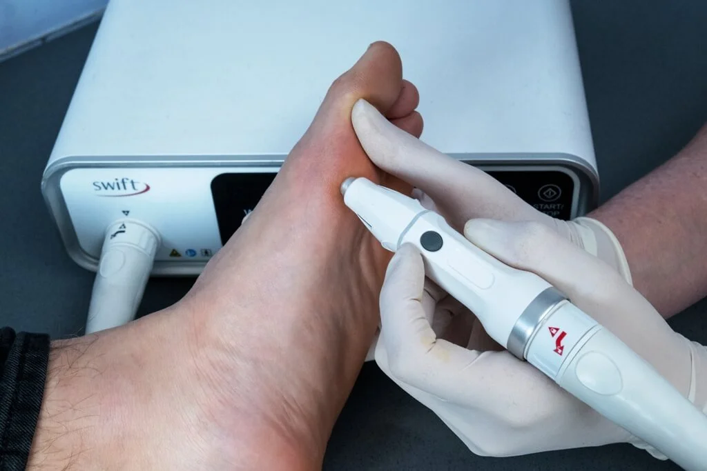 Swift® Wart Treatment is a groundbreaking treatment uses low-dose microwave energy to target and treat the underlying HPV virus, stimulating a natural immune response in the body.