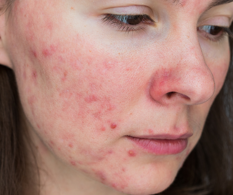 Why Most Rosacea Treatments Miss The Mark