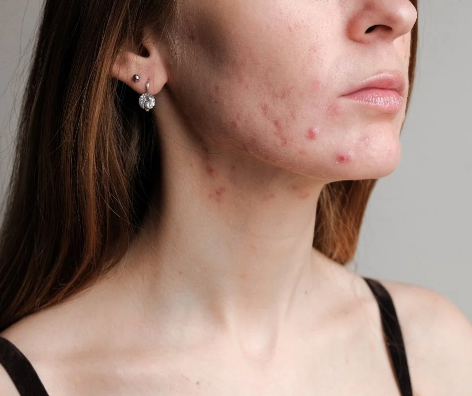 Skin Barrier damage can cause acne and inflammation