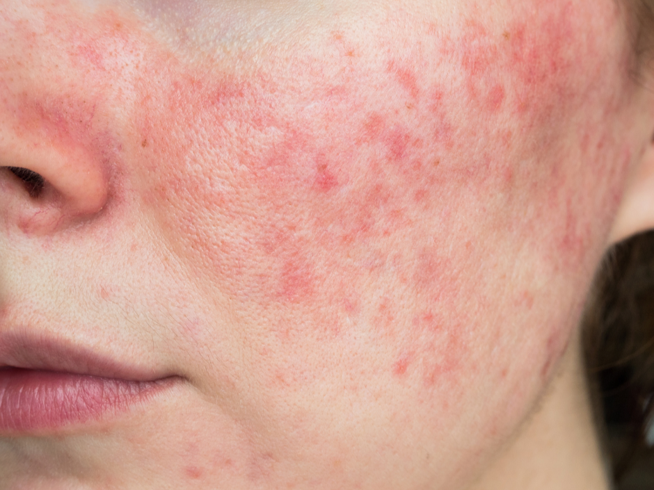 How to treat Rosacea in Charlottesville Va