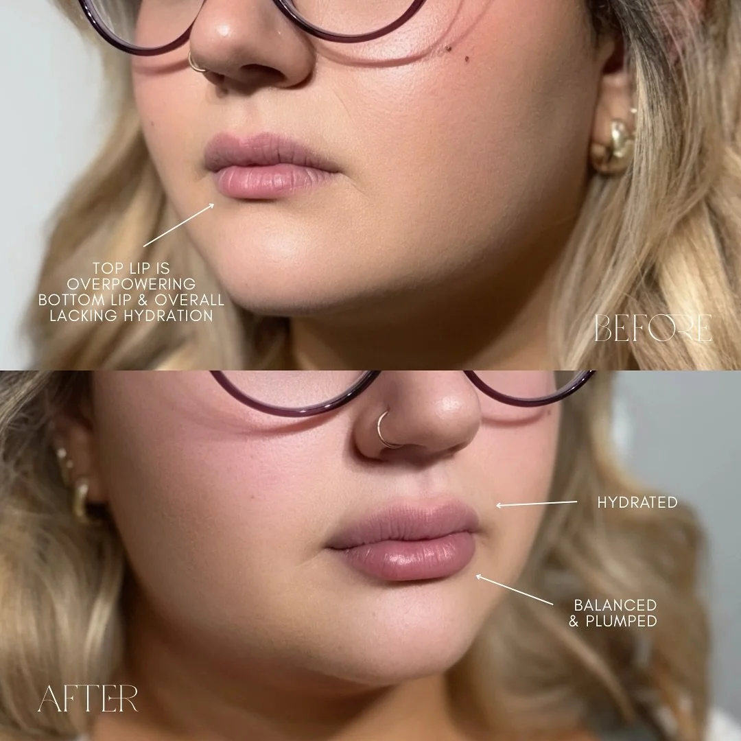 Healed &amp; balanced 💋 our client is in love with her beautiful healed results 💉✨️ #LipFillerTransformation