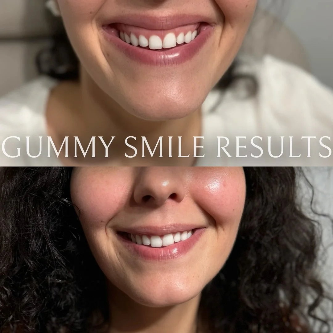 Your smile, beautifully elevated ✨ Confidence that shines through with natural, balanced results 🤍 #SmileEnhancement