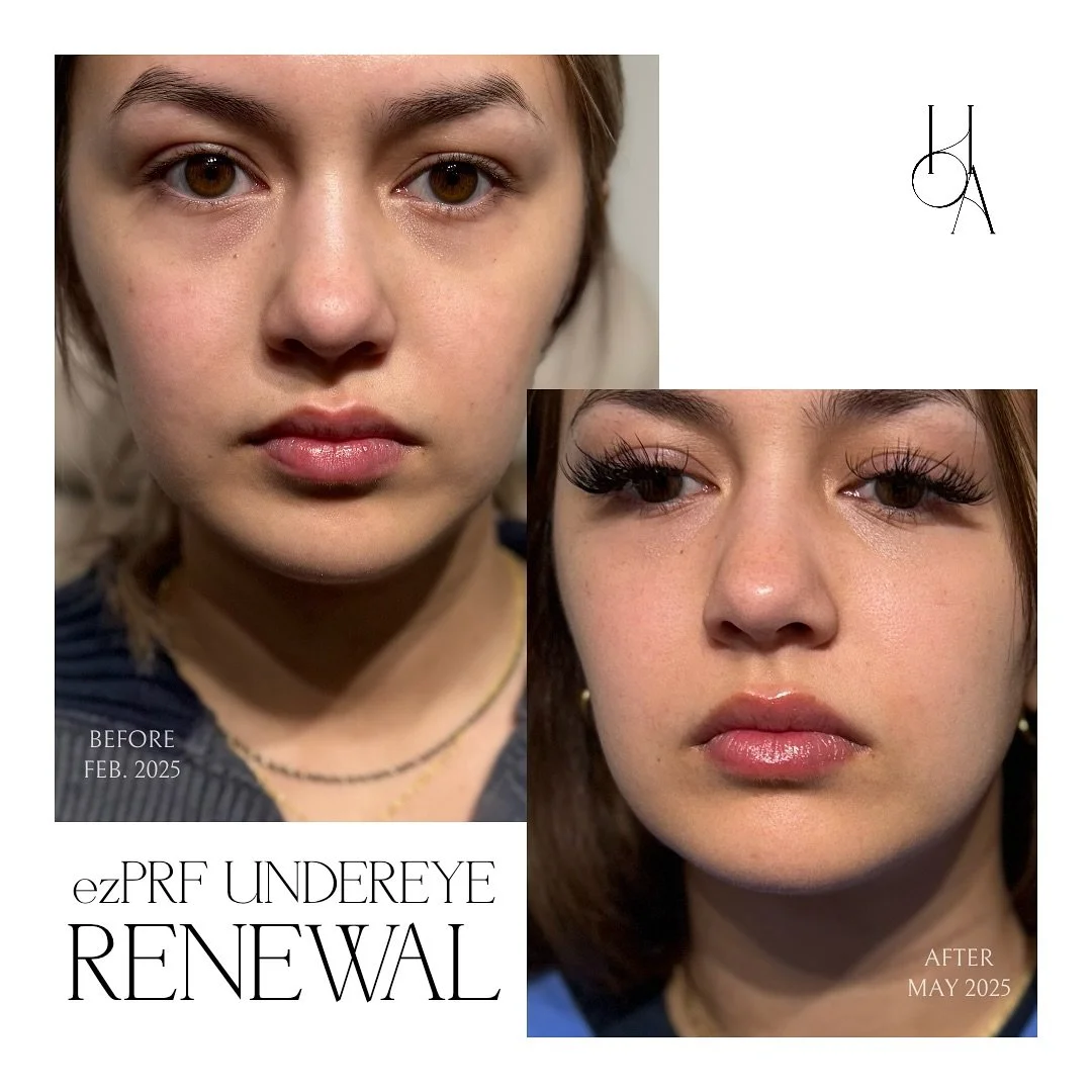 Results after completing our ezPRF Undereye Renewal Package✨ &mdash; a series of three treatments.
Before photo: taken before starting treatment
After photo: 3 weeks post-final session

ezPRF targets dark circles and brightens tired-looking eyes &mda